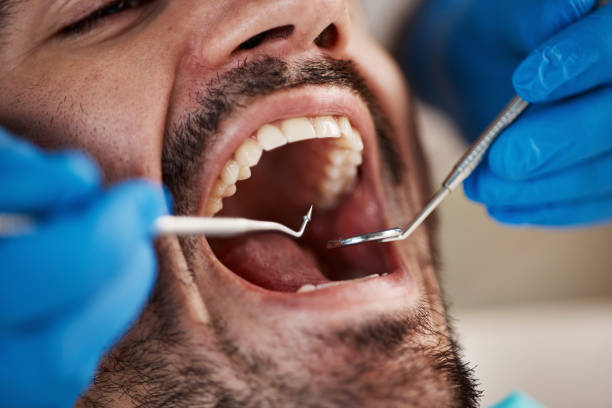 Best Emergency Dental Care for Broken or Chipped Teeth in Rochester, WA